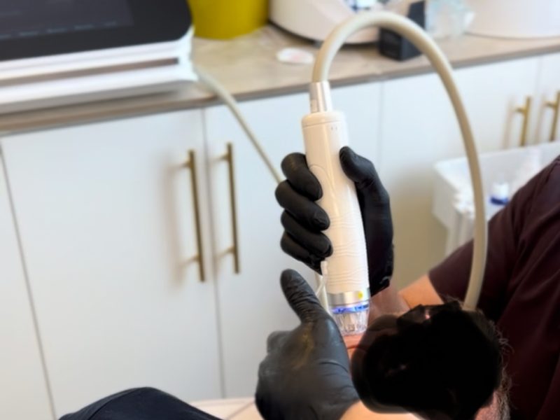 Derma: Radio frequency micro needling device